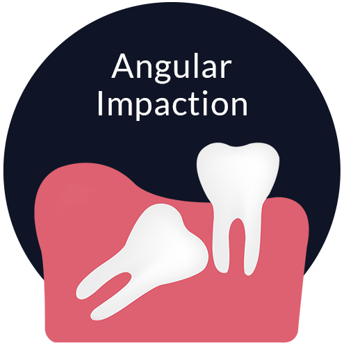 Angular Impaction Johor Bahru (JB) | Dental Clinic Johor Bahru (JB) | Children Friendly Dentist Johor Bahru (JB) | Invisalign Johor Bahru (JB)