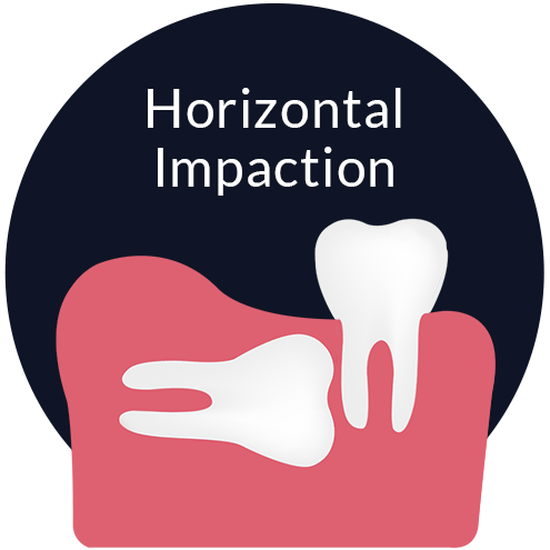 Horizontal Impaction Johor Bahru (JB) | Dental Clinic Johor Bahru (JB) | Children Friendly Dentist Johor Bahru (JB) | Invisalign Johor Bahru (JB)