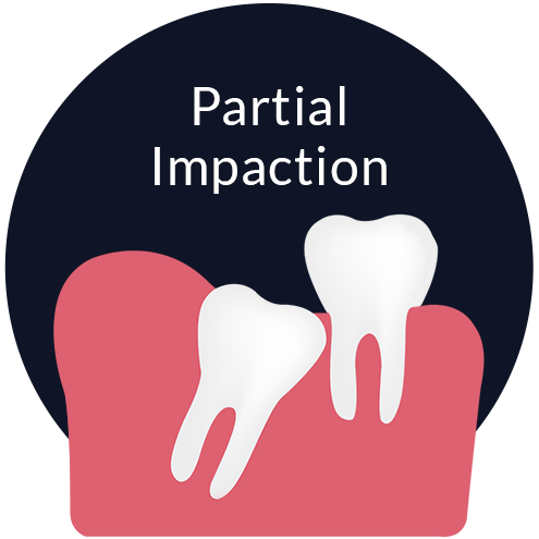 Partial Impaction Johor Bahru (JB) | Dental Clinic Johor Bahru (JB) | Children Friendly Dentist Johor Bahru (JB) | Invisalign Johor Bahru (JB)