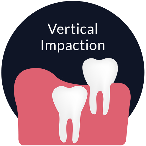 Vertical Impaction Johor Bahru (JB) | Dental Clinic Johor Bahru (JB) | Children Friendly Dentist Johor Bahru (JB) | Invisalign Johor Bahru (JB)