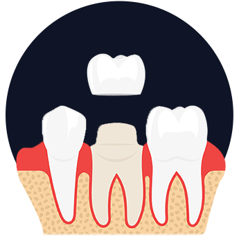 Crown and Bridge Johor Bahru (JB) | Dental Clinic Johor Bahru (JB) | Children Friendly Dentist Johor Bahru (JB) | Invisalign Johor Bahru (JB)