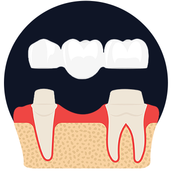 Crown and Bridge Johor Bahru (JB) | Dental Clinic Johor Bahru (JB) | Children Friendly Dentist Johor Bahru (JB) | Invisalign Johor Bahru (JB)