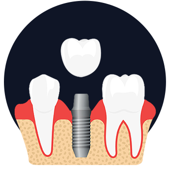 Crown and Bridge Johor Bahru (JB)  Dental Clinic Johor Bahru (JB) | Children Friendly Dentist Johor Bahru (JB) | Invisalign Johor Bahru (JB)