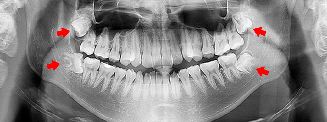 Impacted Wisdom Tooth Treatment Johor Bahru (JB) | Dental Clinic Johor Bahru (JB) | Children Friendly Dentist Johor Bahru (JB) | Invisalign Johor Bahru (JB)