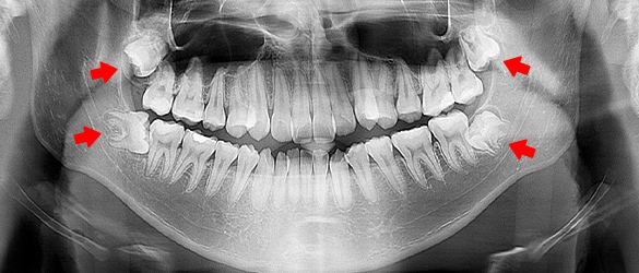 Wisdom Tooth Removal