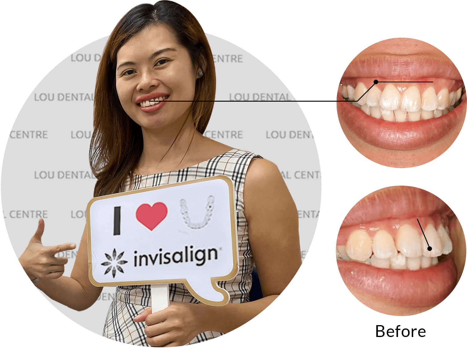 Case Study: Claire Lim smile with invisalign treatment