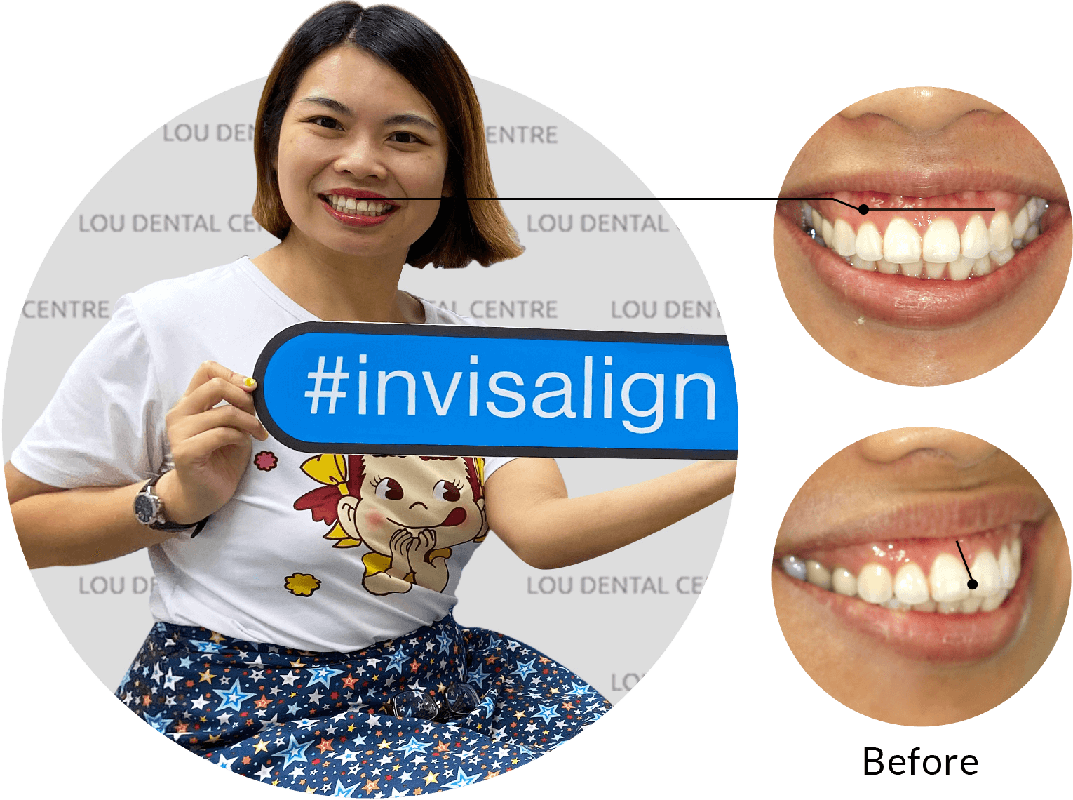 Claire Lim smile with invisalign treatment