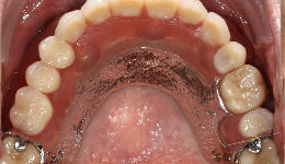 Upper Teeth (Result)	