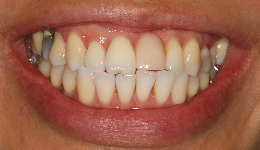 Teeth Protrusion	