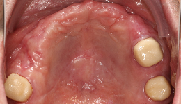 Upper Teeth (Before)	