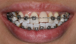 Braces to Correct Teeth Protrusion	