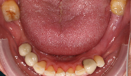 Lower Teeth (Before)	