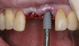 Implants placed immediately after
Extraction of Teeth