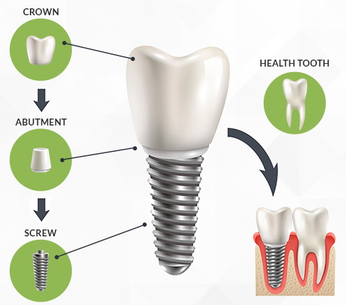Dental Implants Johor Bahru (JB) | Dental Clinic Johor Bahru (JB) | Children Friendly Dentist Johor Bahru (JB) | Invisalign Johor Bahru (JB)