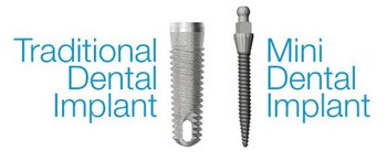 Traditional Dental Implant VS Mini Dental Implant Johor Bahru (JB) | Dental Clinic Johor Bahru (JB) | Children Friendly Dentist Johor Bahru (JB) | Invisalign Johor Bahru (JB)